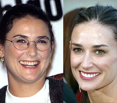 Demi Moore before and after dental work