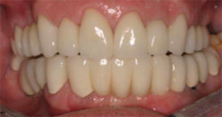 Photo of dental implants after placement