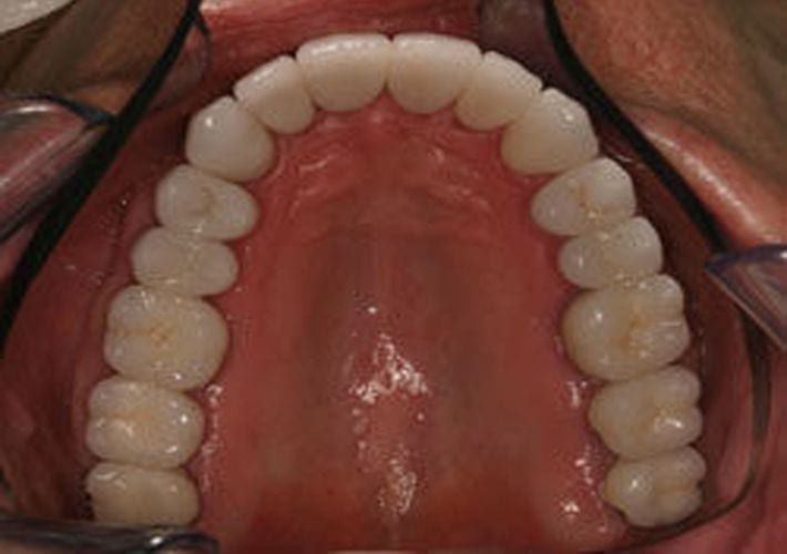 Picture of a Full Mouth Rehabilitation with no metal fillings