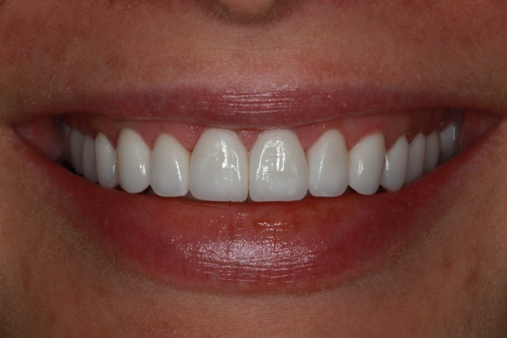 Picture of perfectly straight and white front teeth