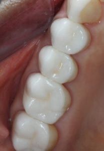 Picture of the Inlays & Onlays placement in the mouth
