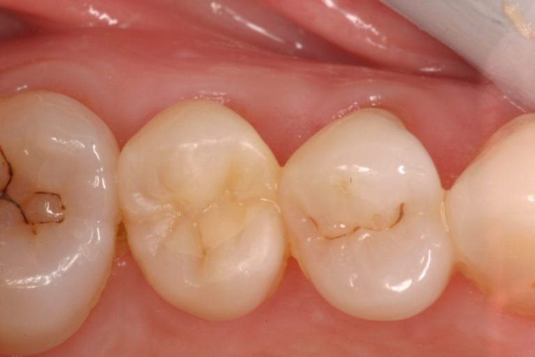 Picture showing Metal-Free Fillings