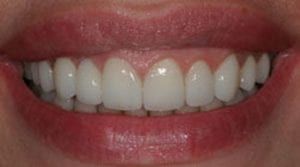Close up of the After results of Porcelain Crowns & Bridges