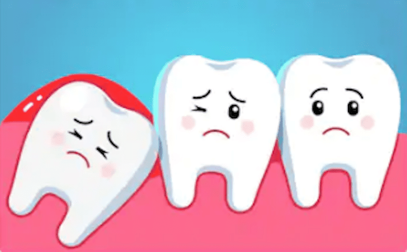 cartoon of impacted wisdom tooth