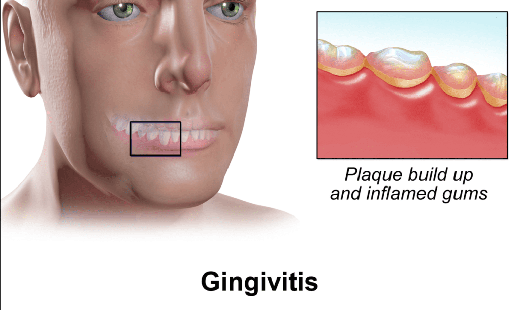 graphic of gingivitis
