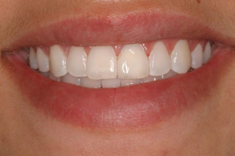 Close up of the after result of teeth whitening