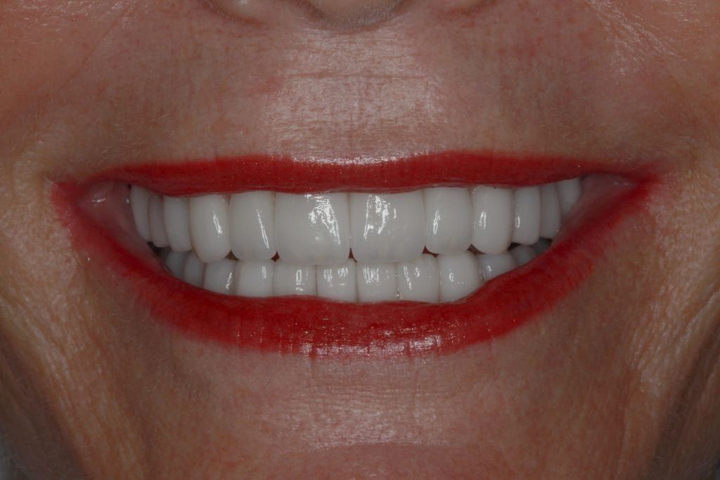 Close up of a perfectly straight and white teeth smile