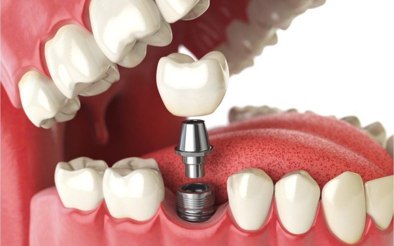graphic of dental implant