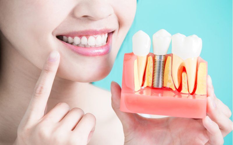 woman smiling while holding a clay of dental implant