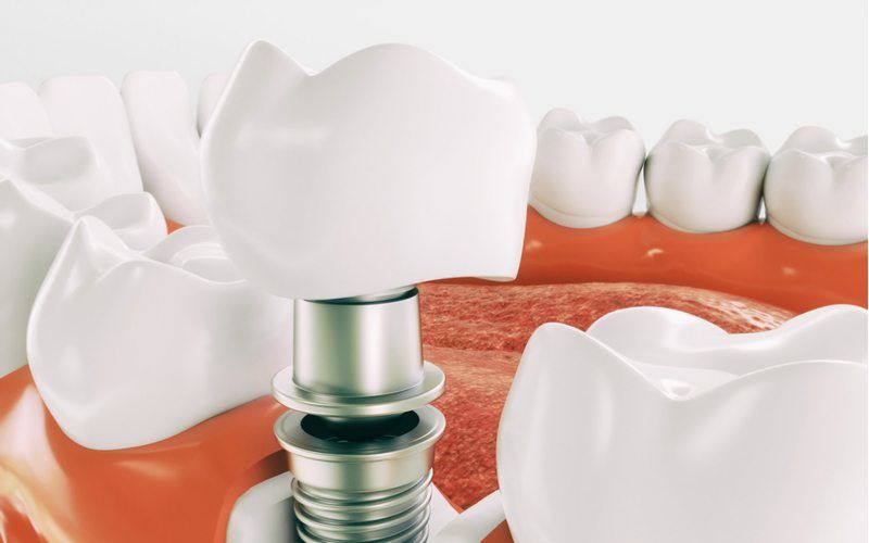 graphic of a dental implant