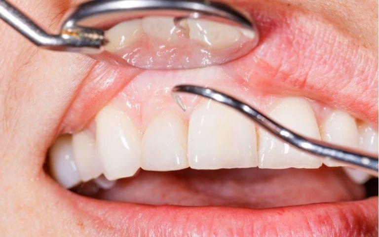 Treatment Of Periodontal Disease West Palm Beach Dentist