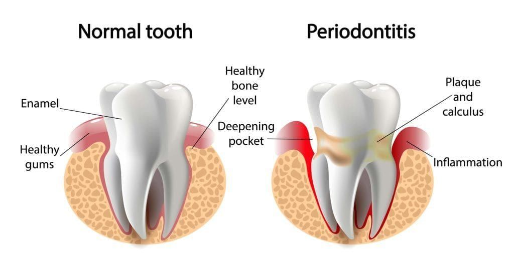 Graphic of a normal tooth and one with Periodontitis, a gum disease