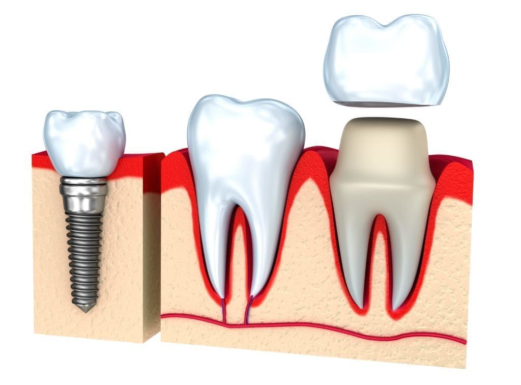 Graphic of a dental implant and crown