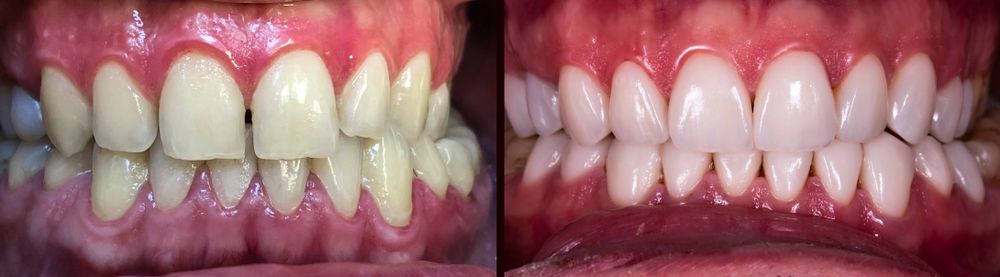 Close up of mouth before and after Veneers