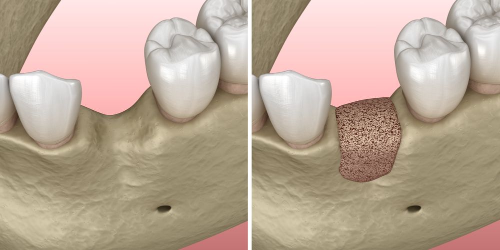 Graphic of before and after gum lift
