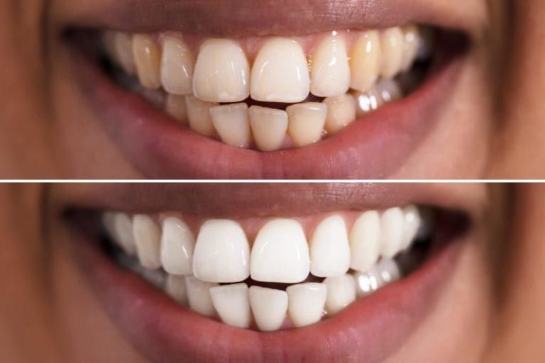 Close up of teeth before and after teeth whitening