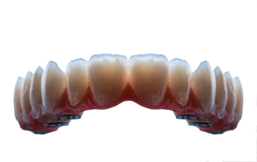 bottom denture implants