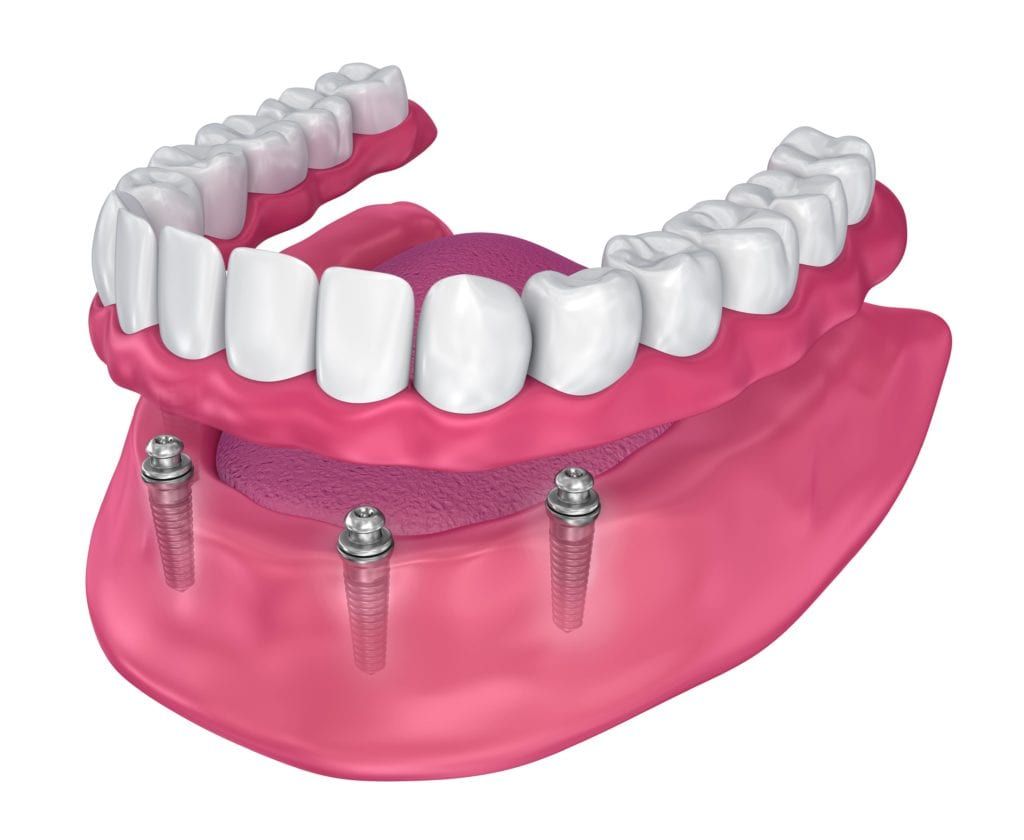 Computerized image of three dental implants in the gums that are being used to support a denture
