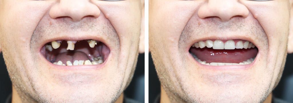 Before and after for a full mouth reconstruction