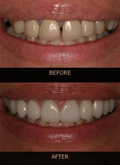 Before and after shot of teeth treated with cosmetic dentistry