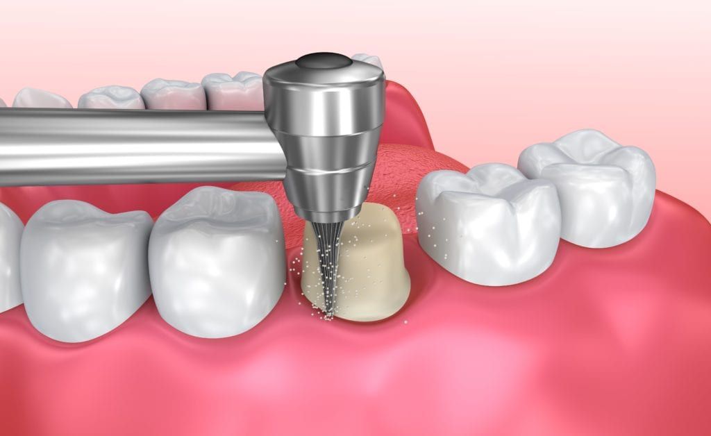 computerized image showing the preparation for a dental crown
