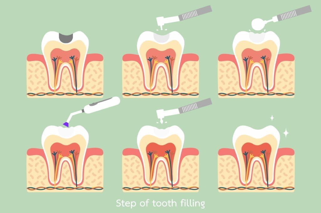 Steps of a tooth filling