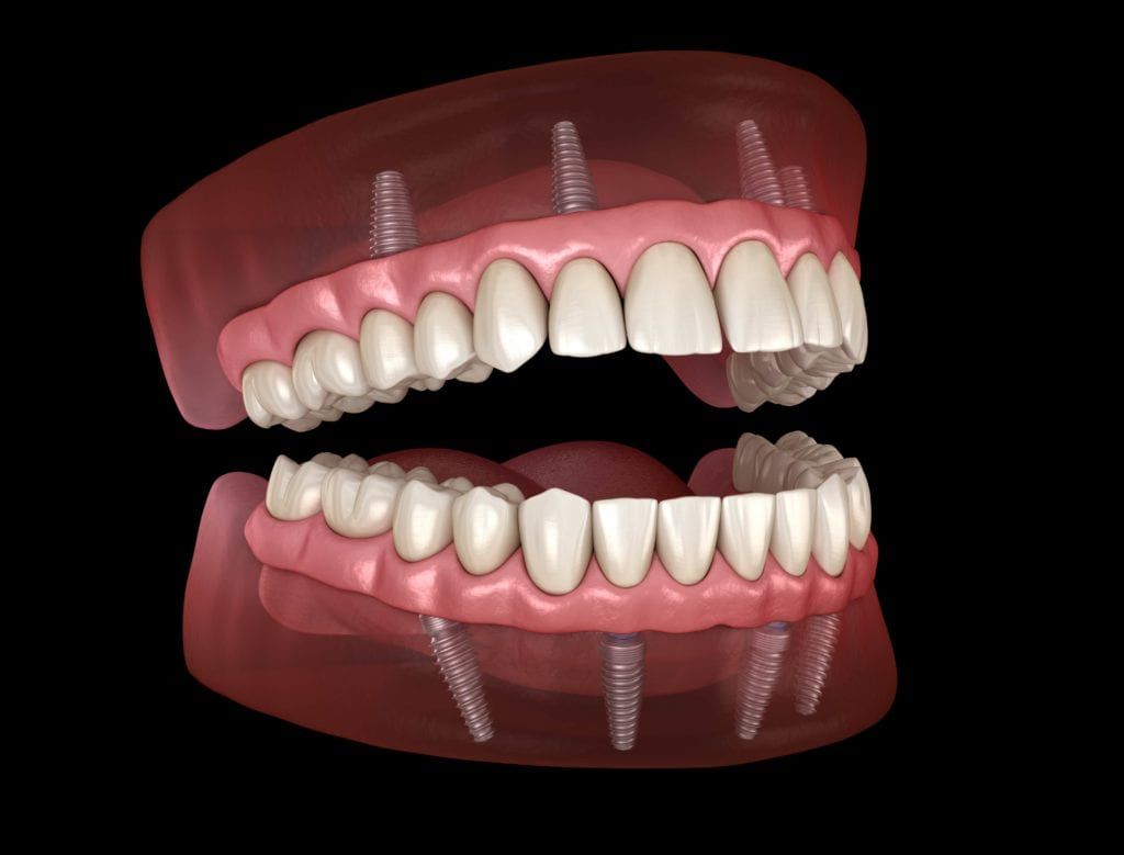 full mouth rehabilitation with implant supported dentures