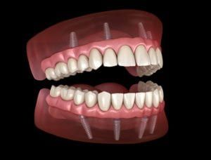 graphic of full mouth rehabilitation with implant supported dentures