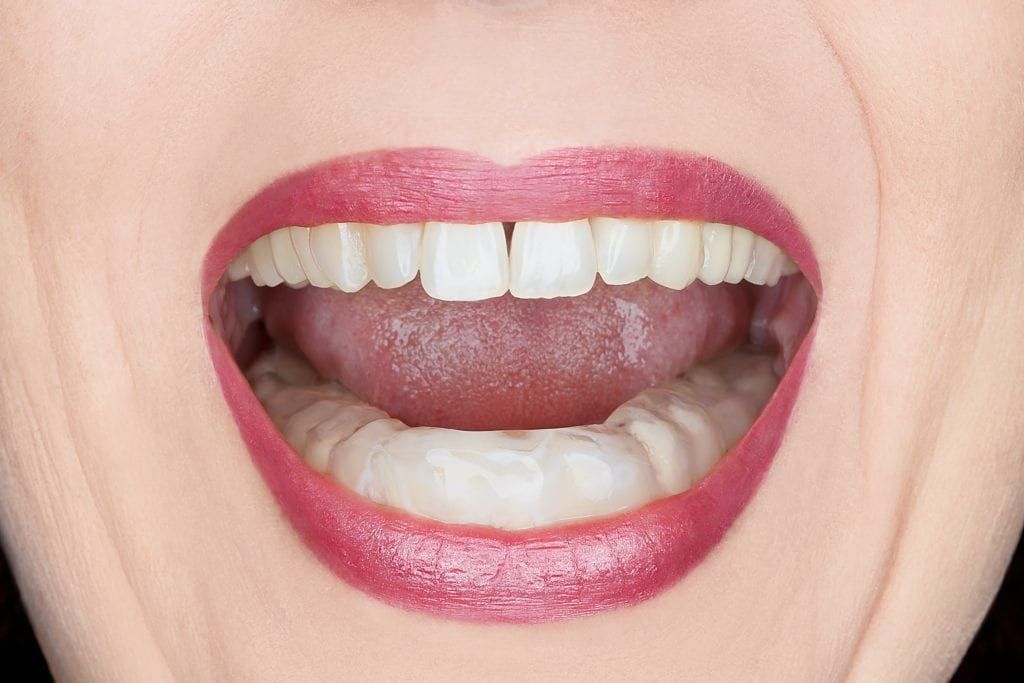 Woman wearing a dental splint on her lower teeth