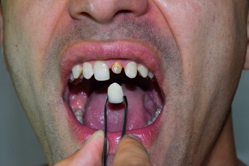 Man with severely damaged tooth getting a dental crown