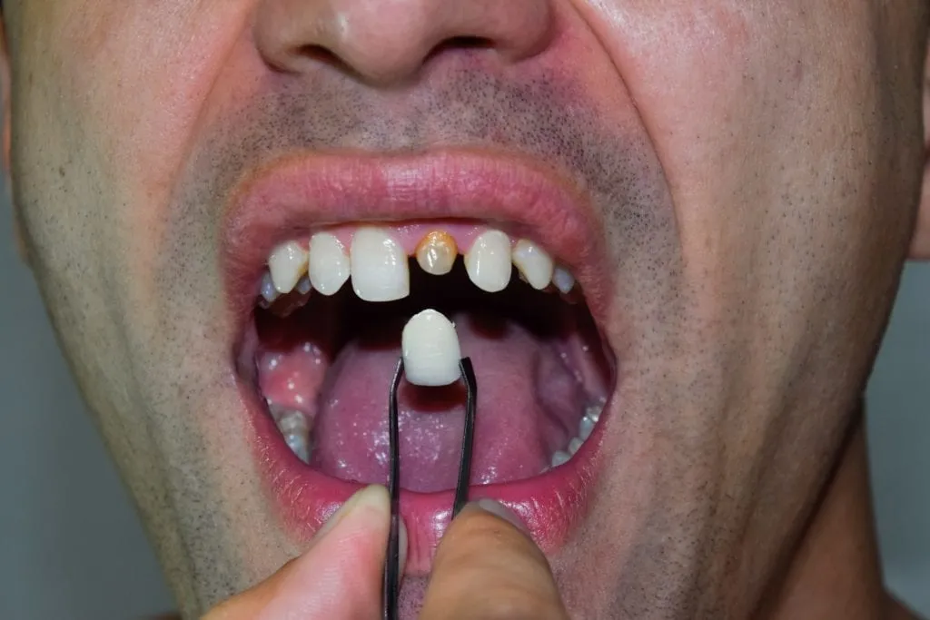 Homem com severamente danificado dente recebendo uma coroa dentária