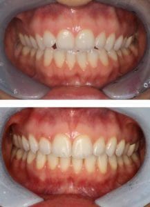 Teeth before and after Invisalign