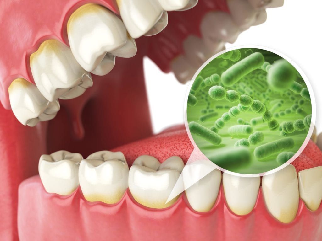 Bacteria buildup on teeth