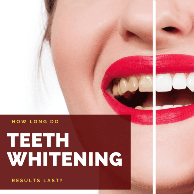 how-long-do-teeth-whitening-results-last-west-palm-beach-dentist