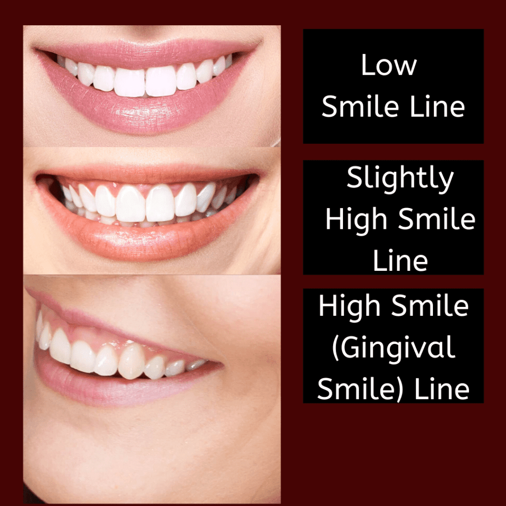 smile lines
