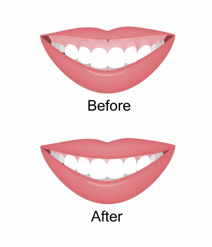 Before and after gum shaping procedure