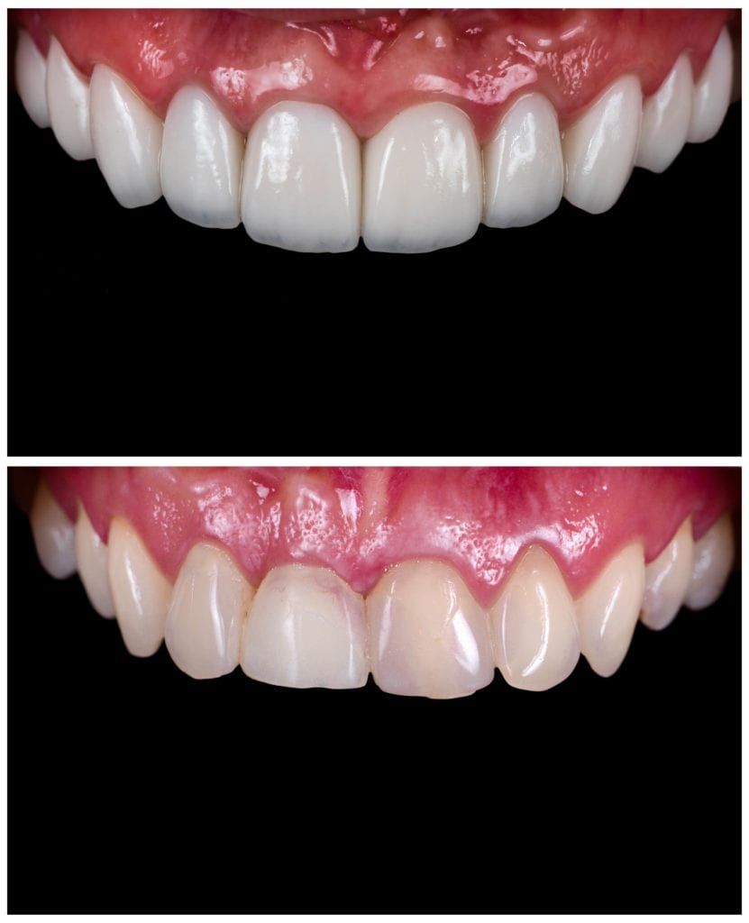 before and after enamel contouring