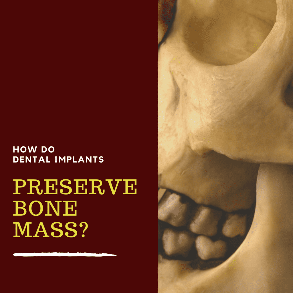 How Do Dental Implants Preserve Bone Mass