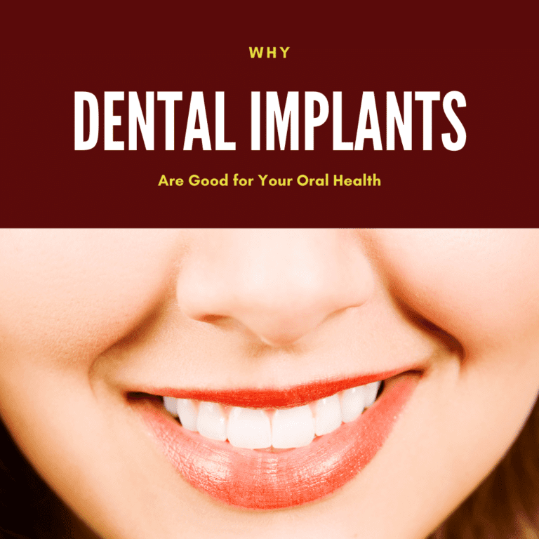 Why dental implants are good for your oral health