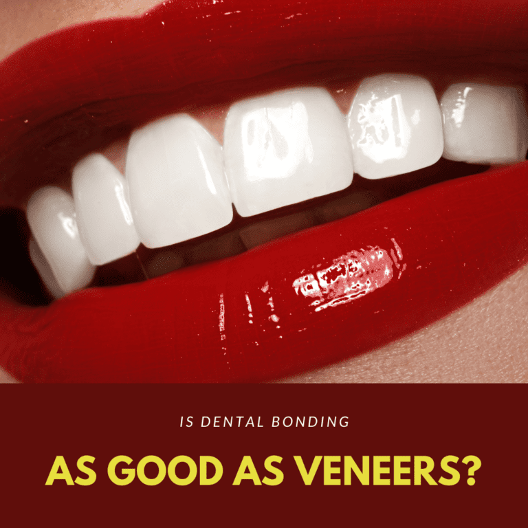 Is Dental Bonding as good as veneers