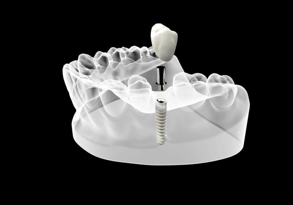 single dental implant shown in bone