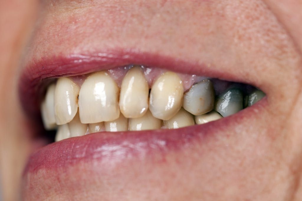 closeup of stained teeth and gums from metal filling