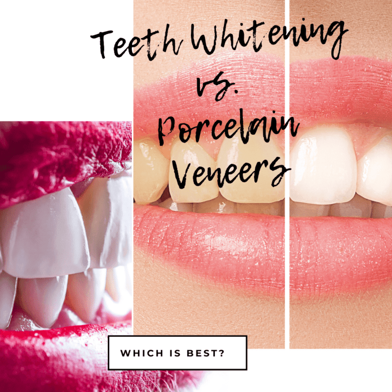 Teeth Whitening vs. Porcelain Veneers