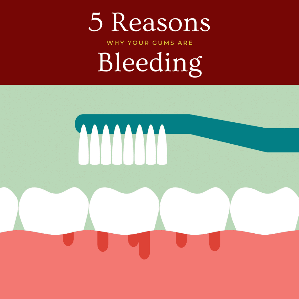 5 Reasons why gums bleed