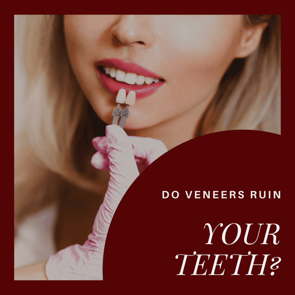 Do Veneers Ruin your teeth3