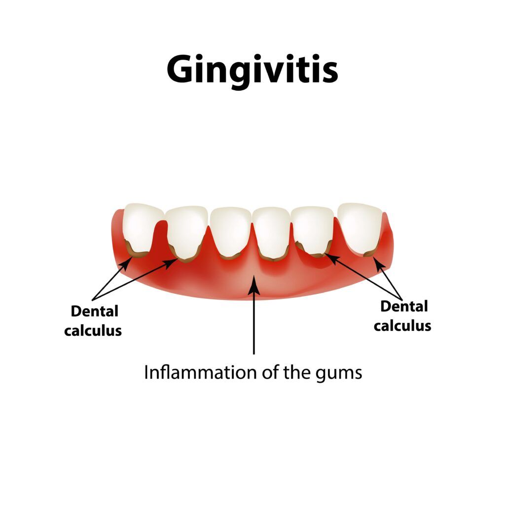 gingivitis diagram