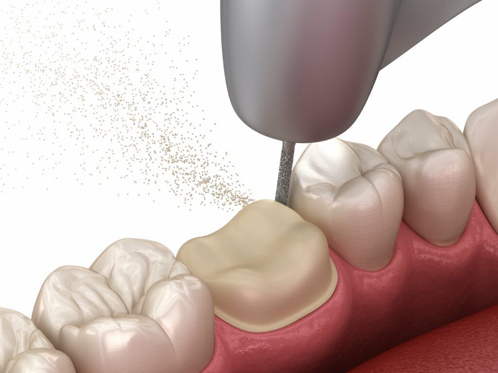 tooth being prepared for dental crown