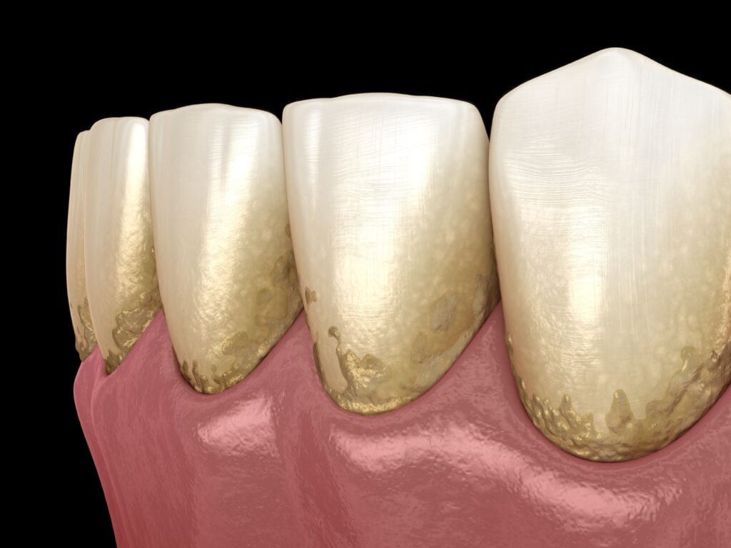 dental plaque on teeth