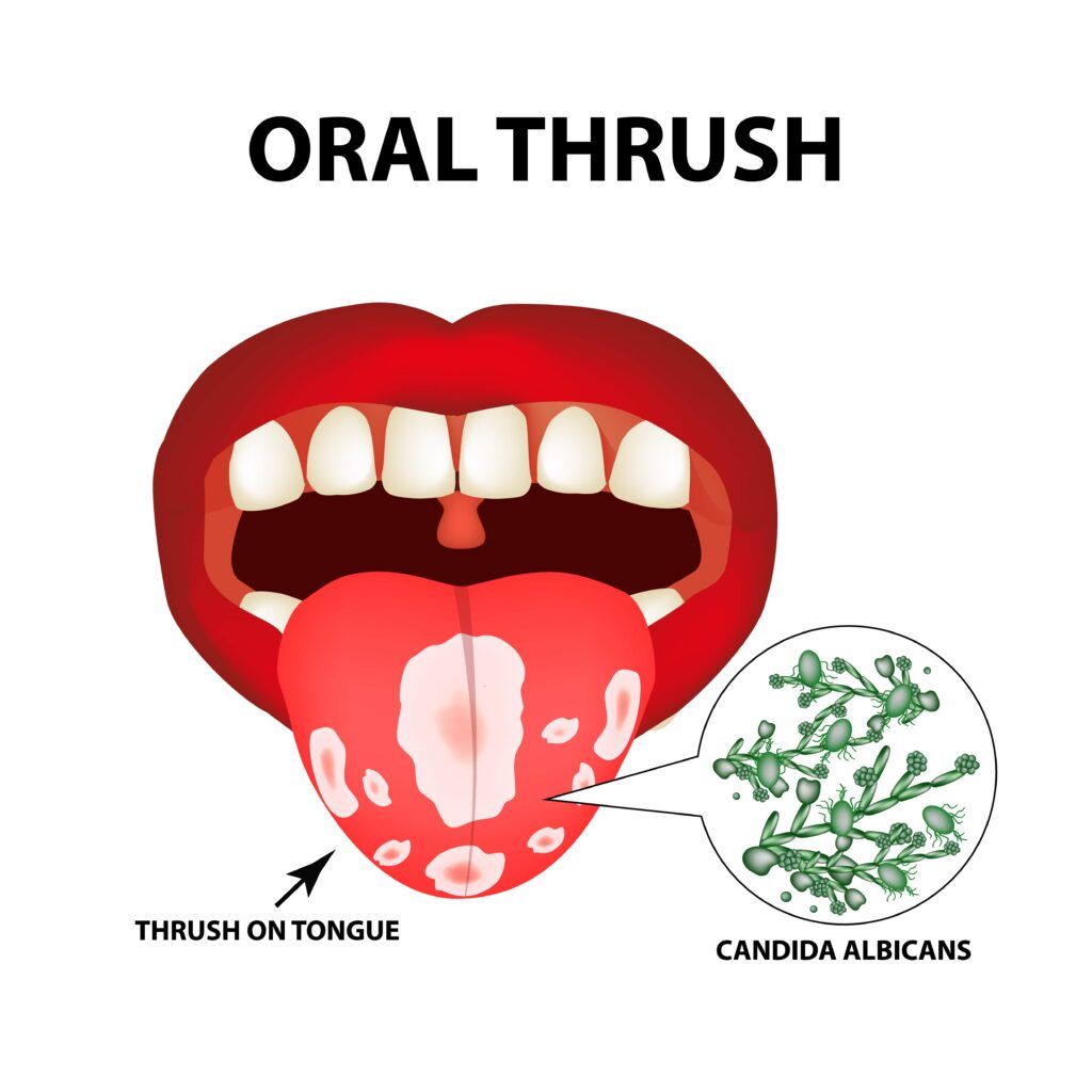 oral thrush