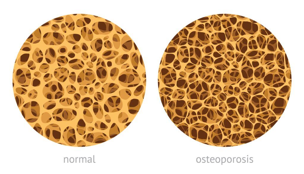 normal bone vs. bone with osteoporosis